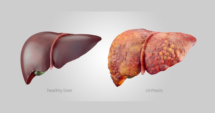 How To Heal Cirrhosis of the Liver How To Heal Cirrhosis of the Liver