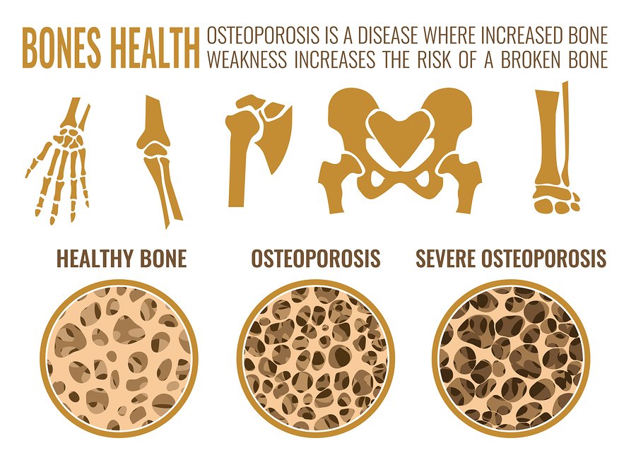Osteoporosis-Stages-Graph