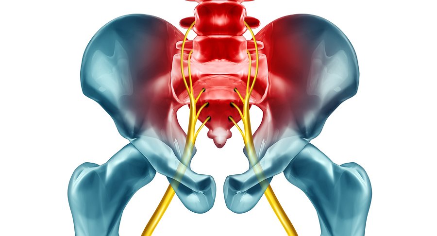 Sciatica, Compressed Nerve Pain