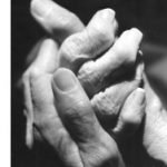 Arthritis