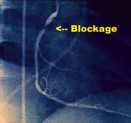 angiogram