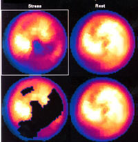 Thallium Stress Test