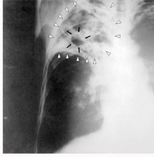 Tuberculosis