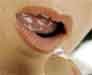 Hormone Replacement Therapy