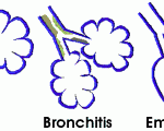 COPD