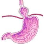 Hiatal Hernia