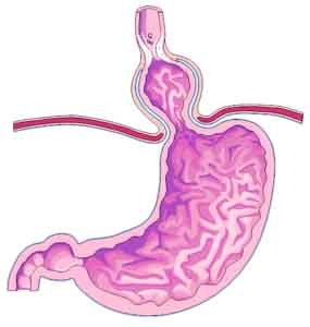 Hiatal Hernia