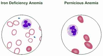 anemia