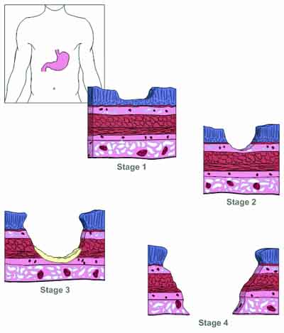 peptic ulcer