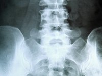 steroid-injections-could-cause-bone-fractures