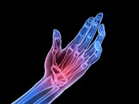 Risk Factors for Arthritis