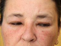 Natural Allergy Remedies