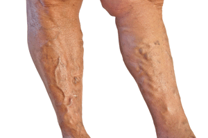 varicose veins, spider veins