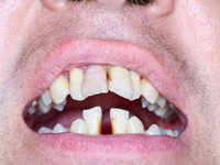periodontal-problems.jpg