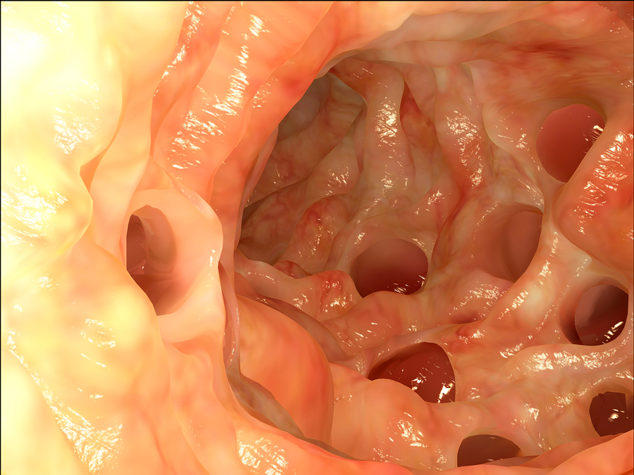 diverticulae.jpg