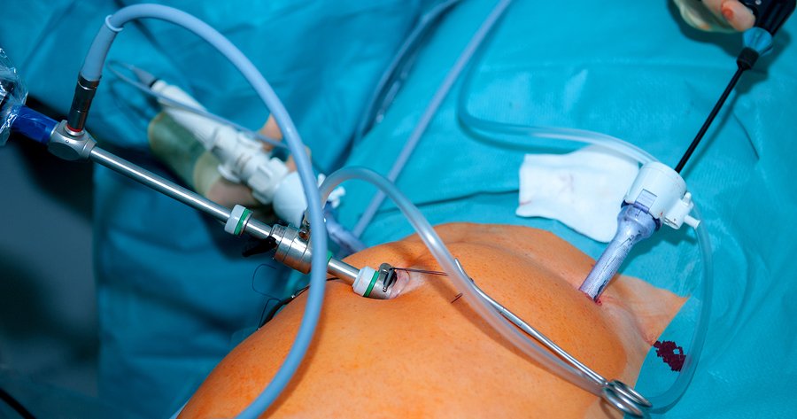 Always Opt For Minimally Invasive Surgery | Natural Health Blog