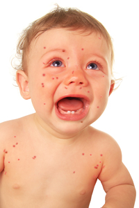 baby with measles crying