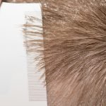 Natural Solutions to Kill Lice | Health Blog