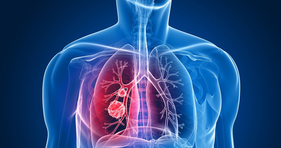 Increasing Lung Cancer & Radon Gas | Natural Cancer Alternatives Blog