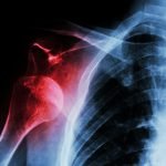 Why Shoulder Surgery Not Needed | Health Blog