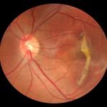 Carotenoids Benefit Our Eyes | Health Blog