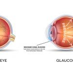 Leafy Greens for Glaucoma Prevention | Health Blog