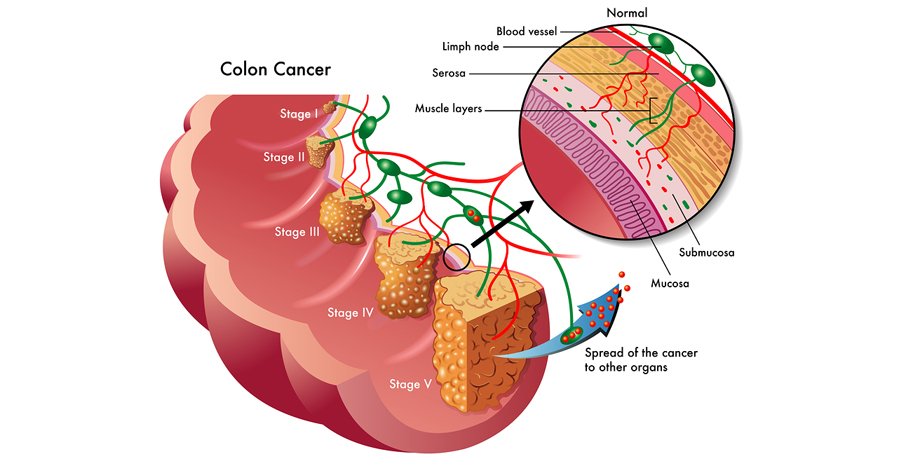 Colon Cancer Rates | Alternative Cancer Remedies Blog