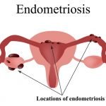 Natural Remedies Endometriosis | Natural Health Blog