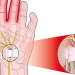 Electroacupuncture For Carpal Tunnel | Anti-Aging Blog