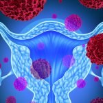 Exercise Prevents Ovarian Cancer | Cancer Alternatives Health Blog