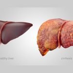 How To Heal Cirrhosis of the Liver