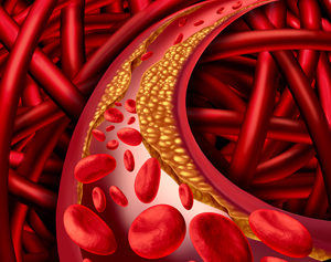 artery blockage illustration