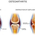 Fiber to Prevent Knee Osteoarthritis | Natural Health Blog