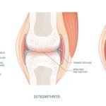 Arthritis in Younger People | Natural Health Blog