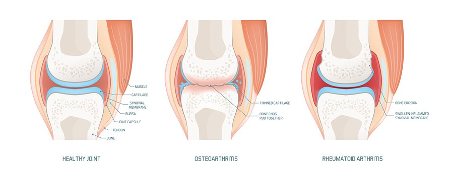 Arthritis in Younger People | Natural Health Blog