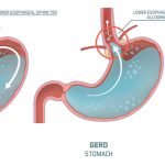 Easing GERD with Melatonin and Probiotics