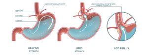 Easing GERD with Melatonin and Probiotics