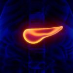 Pancreatic Cancer Due to Obesity