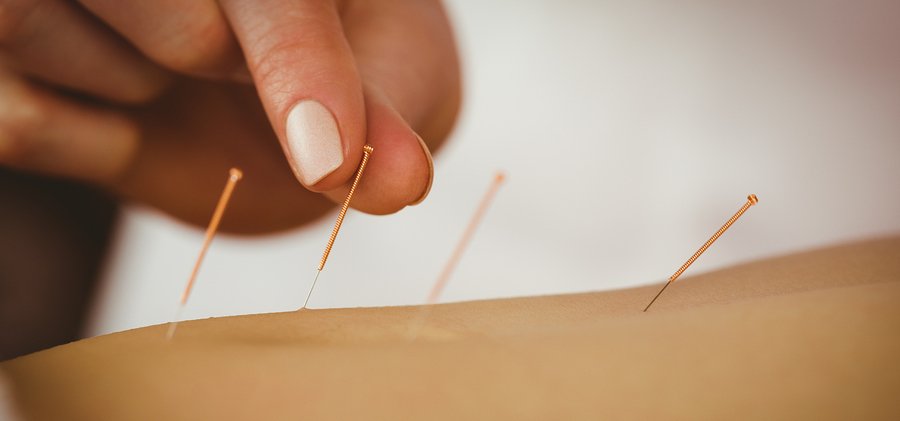 Managing Menopause With Acupuncture