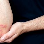 Psoriasis Linked Cancer