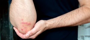 Psoriasis Linked Cancer